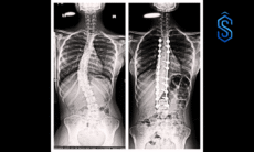 scoliosis