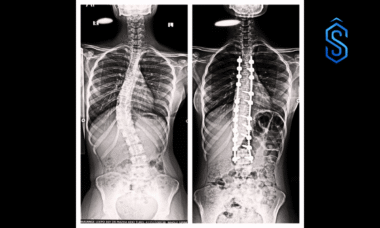 scoliosis
