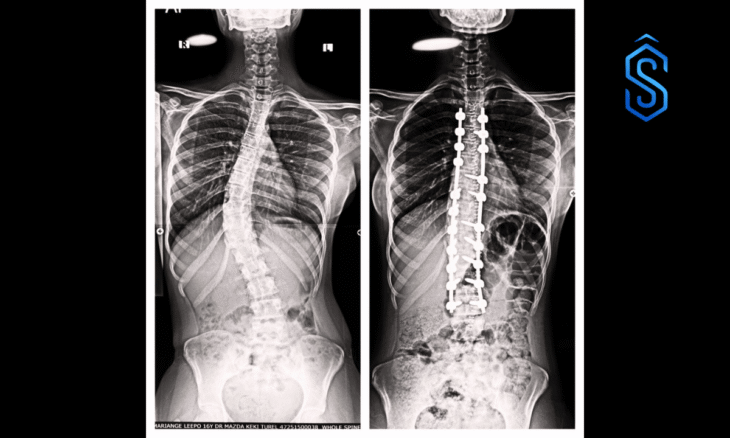 scoliosis