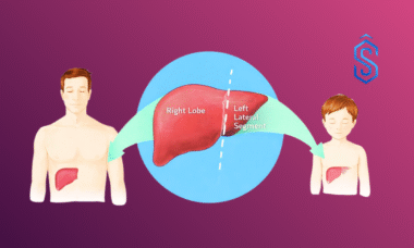 split liver transplant